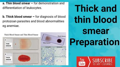 thick and thin smear test|preparation of thin blood smear.